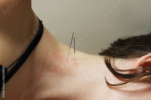 Canvas Print Superficial dry needling for scalene muscles.