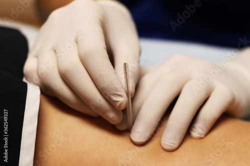 Holding the needle in site during dry needling. 