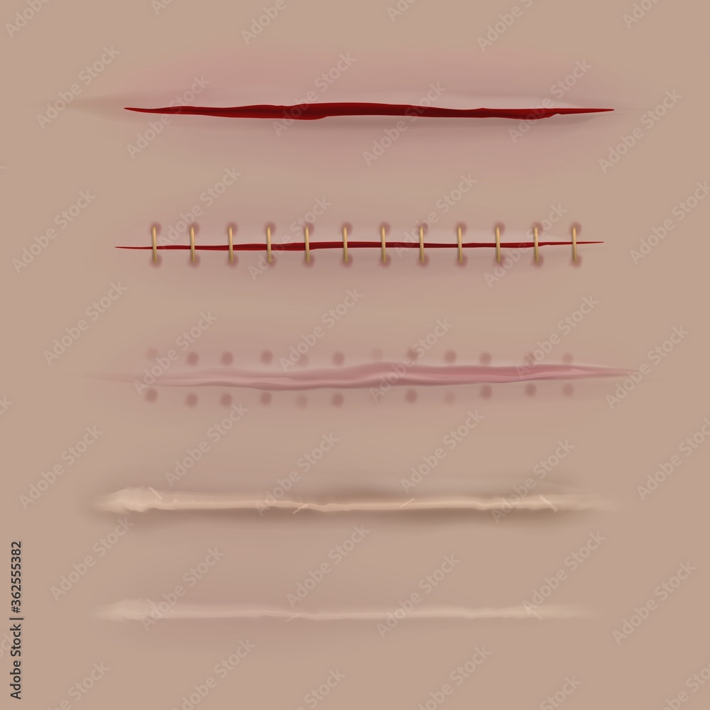 Surgical sutures healing stages. Realistic bloody wound and stitch ...