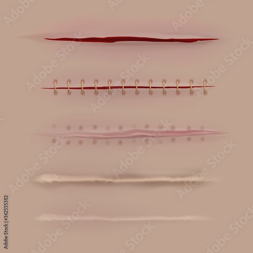 Surgical sutures healing stages. Realistic bloody wound and stitch. Scars, stitched gash different curing steps, medicine vector set
