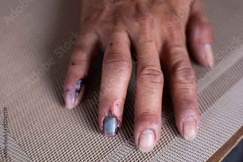 A man's hand injured in an accident,hand injury with blood,Finger with Bruised Nail