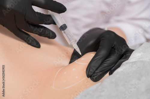 Cosmetologist doctor do lipolytic injection procedure to a woman in her clinic. She wear black glowes and mask and holds syringe with a needle