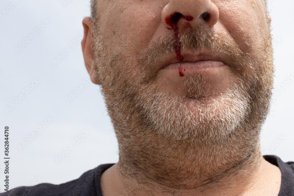 Nosebleed , an old man with a bloody nose. Healthcare and medical concept. Nosebleed , an old man with a bloody nose. Healthcare and medical concept.