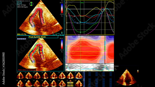 Image of the heart in gray-scale mode during transesophageal ultrasound.
