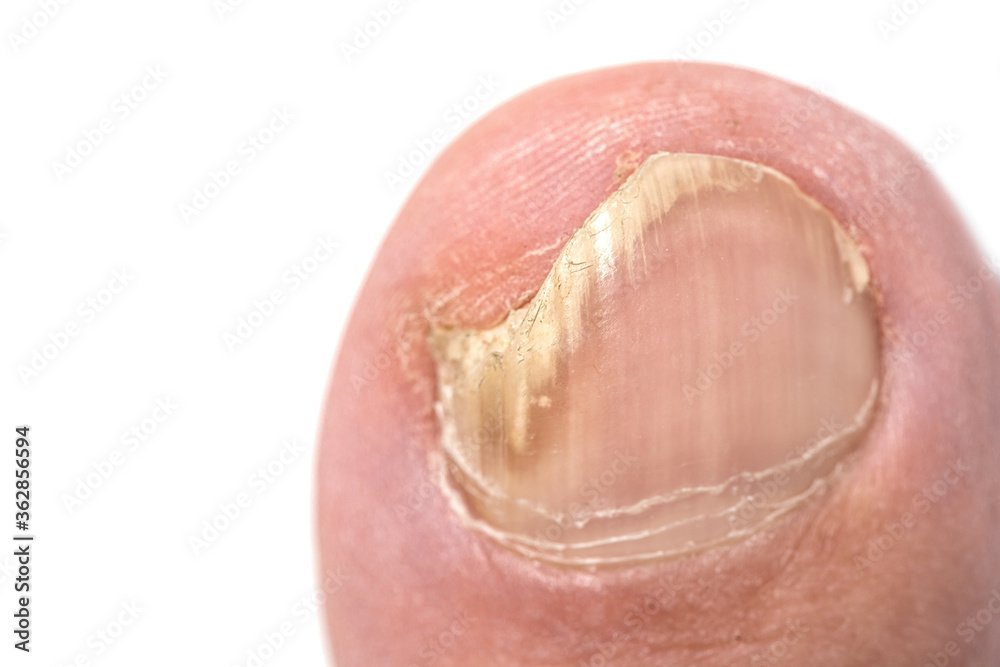 Toenail fungus close up with a human foot isolated on white background Toenail fungus close up with a human foot isolated on white background