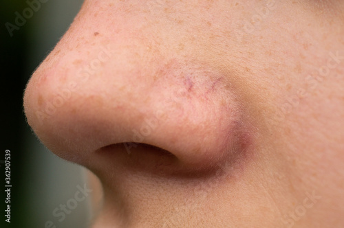 A close-up portrait of a teen girl showing redness and inflamed blood vessels on her nose. 