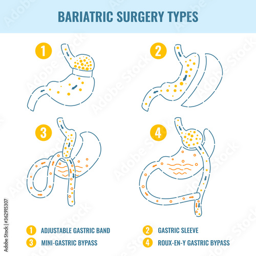 Types of bariatric surgery weight loss procedures- gastric bypass, sleeve gastrectomy, adjustable gastric band. Stomach medical diagram infographics in line style. Vector illustration.