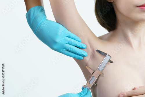 Doctor hand measurement keloids or scar on the armpit after breast surgery with caliper, breast implant surgery concept.