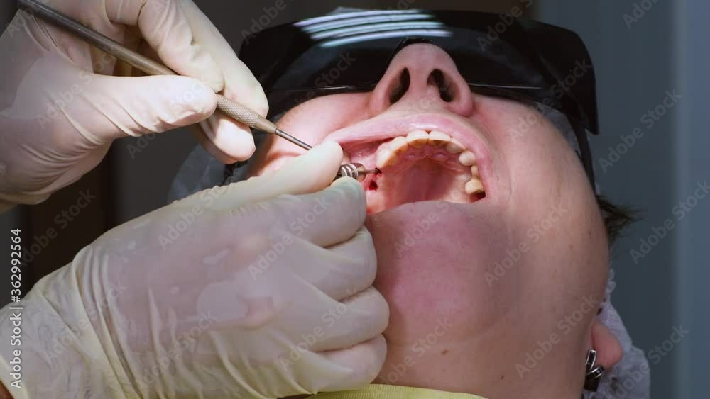 Oral surgeon removing screws from dental implant to install transfers