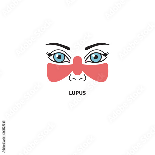 Systemic lupus erythematosus. Woman with red spot on her face