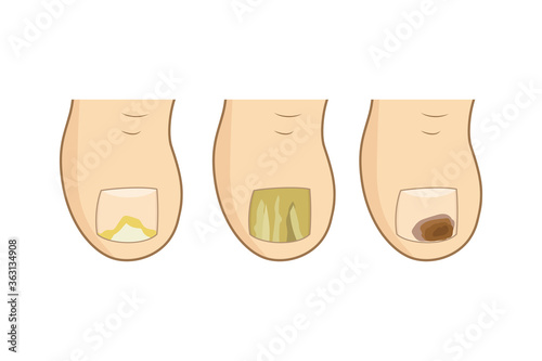 Toenail mycosis types.