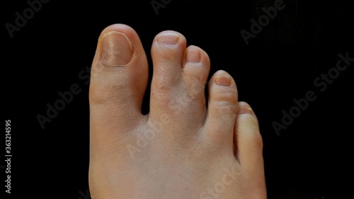syndactyly feet
