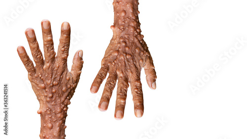 Male hands of neurofibromatosis genetic disorder that causes tumors on skin isolated on white background, with clipping path. photo