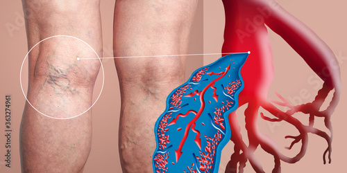 Foto Varicose veins on a female senior legs