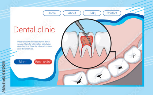 Layout of the site with the treatment of pulpitis, caries, muba, molars, vector stock illustration as a website template