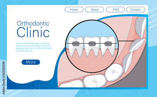 Website layout with services for installing braces and aligning teeth, molars, vector stock illustration as a website template with braces