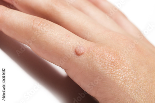Common wart  Verruca vulgaris  a flat wart commonly found on the hand of children and adults. They are caused by a type of human papillomavirus  HPV photo