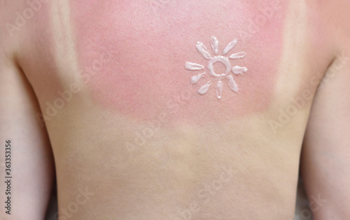 Sunburn and red skin on a female back with a painted sun from a sunblock