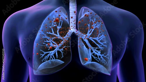 Realistic 3D footage animation of the severe acute respiratory syndrome coronavirus 2 (SARS-CoV-2)  known as 2019-nCoV. Lungs contagion. Novel coronavirus close up.High quality medical animation.