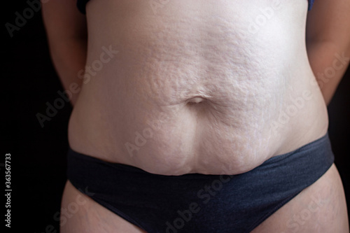 White woman displaying large stretch marks, striae on skin after pregnancy, childbirth. Concept of diastasis recti, lesion skin. Selective focus