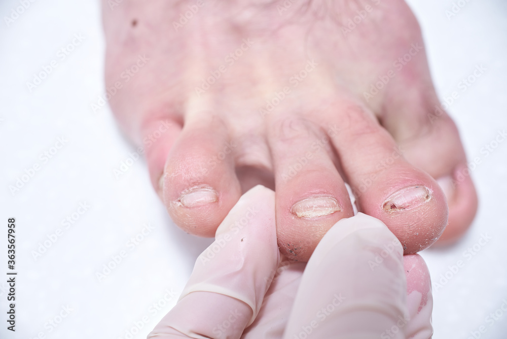 The doctorpodiatrist does an examination of the patient's foot in the