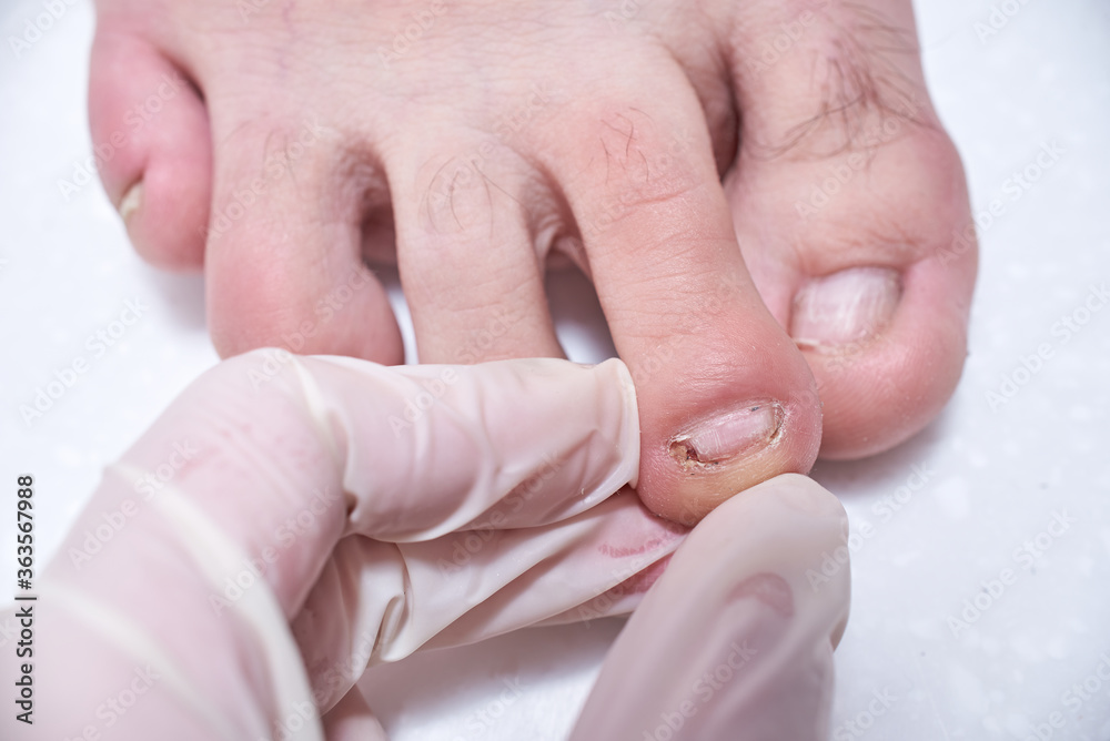 The doctor-podiatrist does an examination  of the patient's foot in the clinic. Podiatrist treating toenail fungus. Podology treatment.