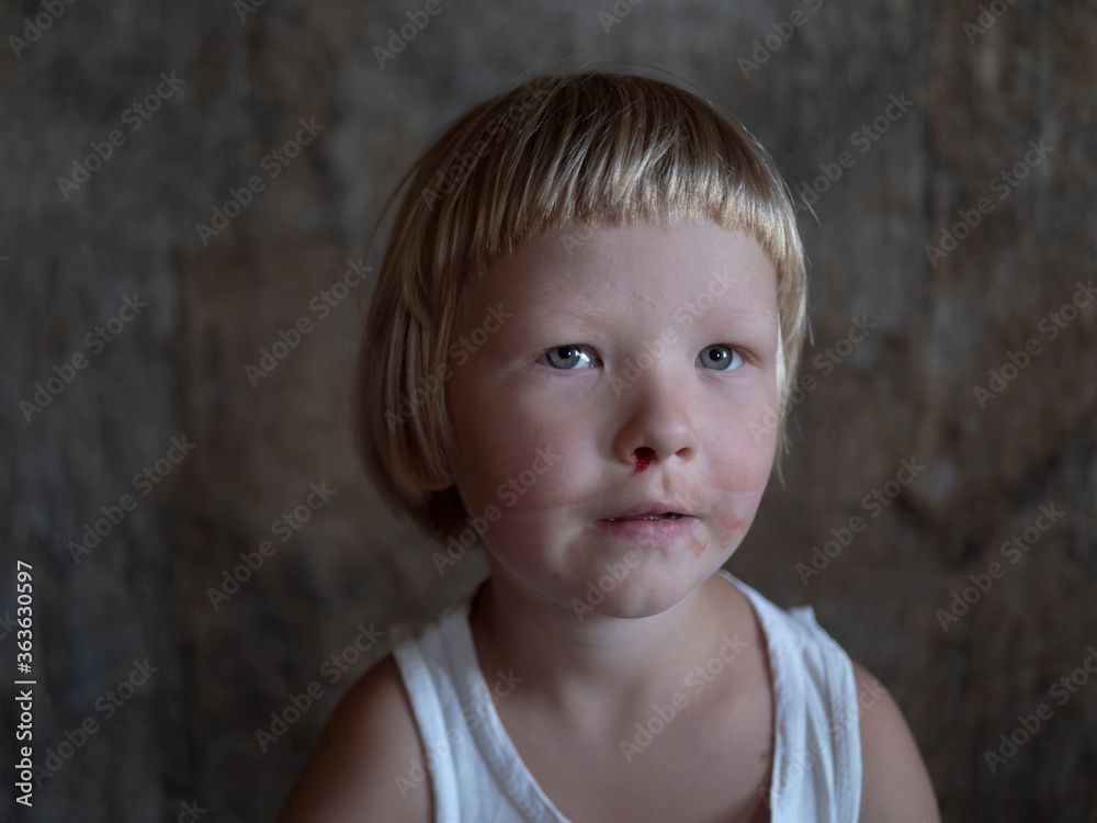 little fair-haired boy is smeared with blood. baby has weak vessels in nose bursting with pressure drops and changes in weather. Hemophilia disease. Blond child lifts his head to stop the bleeding little fair-haired boy is smeared with blood. baby has weak vessels in nose bursting with pressure drops and changes in weather. Hemophilia disease. Blond child lifts his head to stop the bleeding