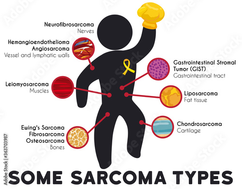 Infographic Showing Some Sarcoma Types and Principal Affected Tissues, Vector Illustration photo