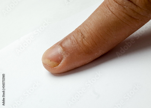 macro photo of finger infected with dermatophyte fungi photo