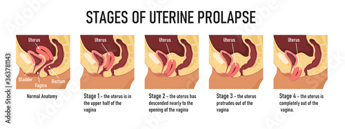 Stages of uterine prolapse. Vector illustration photo