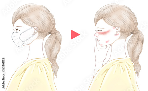 マスクをした横顔の女性とマスク荒れ 摩擦と炎症 Stock イラスト Adobe Stock マスクをした横顔の女性とマスク荒れ 摩擦と炎症 Stock イラスト Adobe Stock