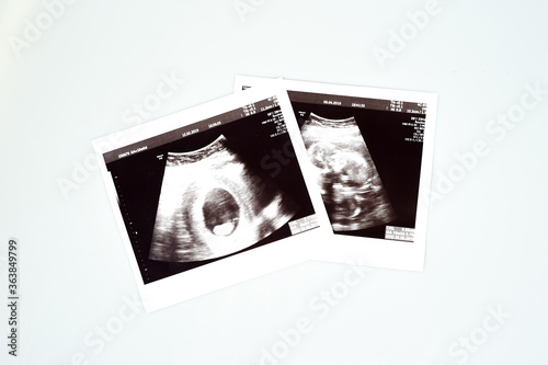 Result of ultrasound picture or ultrasonography for pregnancy on top of white isolated background