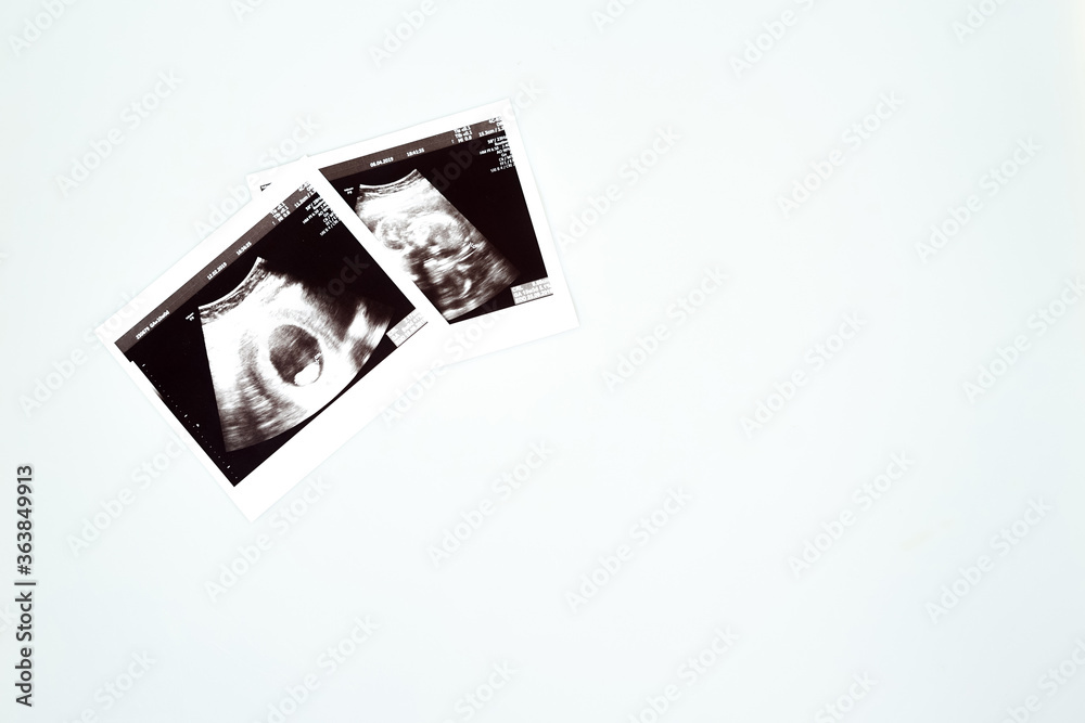 Result of ultrasound picture or ultrasonography for pregnancy on top of white isolated background Result of ultrasound picture or ultrasonography for pregnancy on top of white isolated background