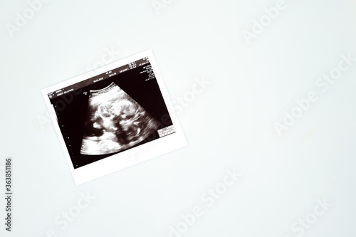Result of ultrasound picture or ultrasonography for pregnancy on top of white isolated background