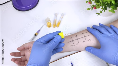 An allergist doctor in the laboratory conducts a prik allergy test. Skin test for household, food, epidermal allergic reactions photo