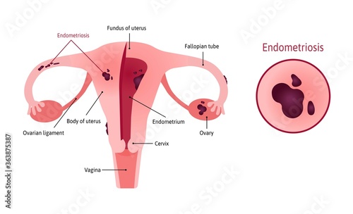Endometriosis of uterus involves ovaries, fallopian tubes and cervix. Endometriosis close up. Womb witj vagina and ovary. Marked with lines. Vector medical illustration.