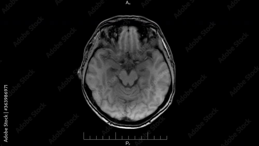 MRI head scan, resonance imaging of a human brain closeup