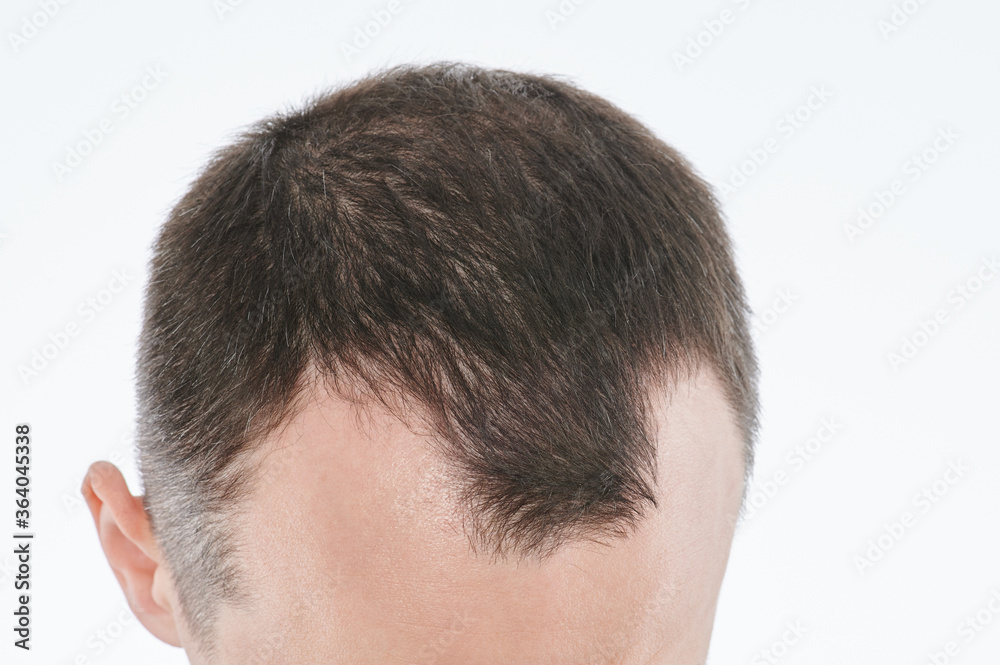 Obraz premium Man loosing hair theme