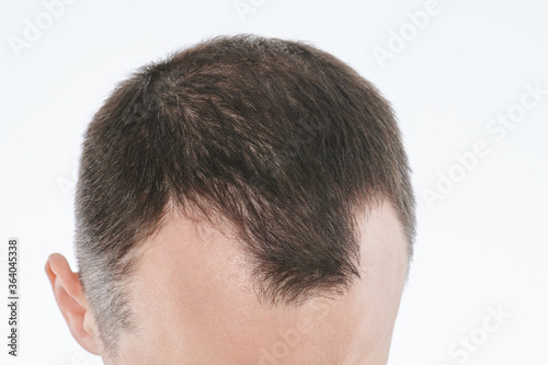 Man loosing hair theme