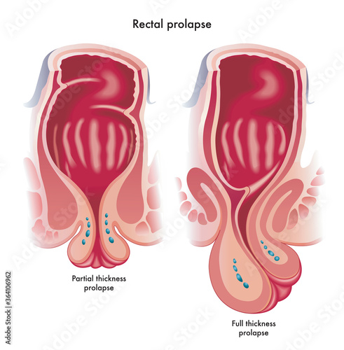 Medical illustration showing two types of rectal prolapse, a partial thickness prolapse, and a full thickness prolapsed.