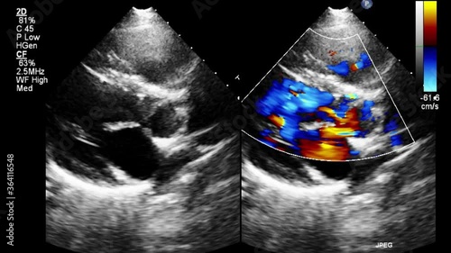 Transesophageal ultrasound video in Doppler mode. photo