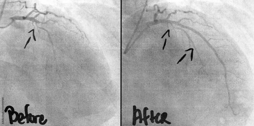 Fototapeta premium Coronary Angiogram imaging showing before and after three stents, ballooning of two occlusions was performed by a cardiac surgeon. a life saving intervention for the 54 year old man.