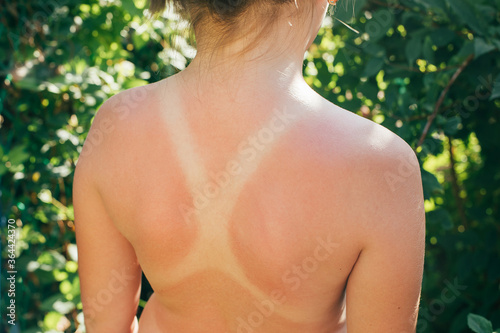 Sunburn. Little girl sunburn on back. Skin care concept © Anikonaann