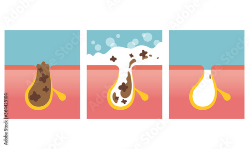 Pore cleansing, facial skin care image. Washing skin with soap. Vector illustration in flat cartoon style.