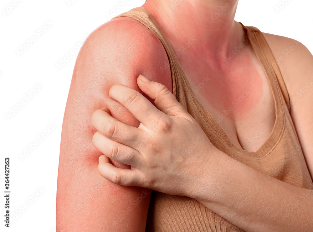 Woman with red sunburned skin against white background, closeup Woman with red sunburned skin against white background, closeup