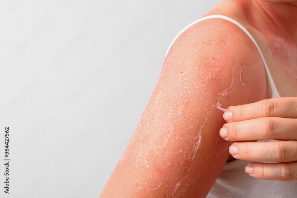 Woman with red sunburned skin against light background, closeup Woman with red sunburned skin against light background, closeup