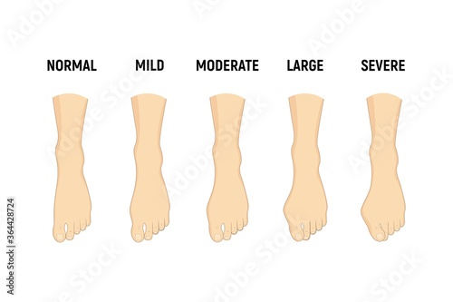 Hallux valgus disease stages