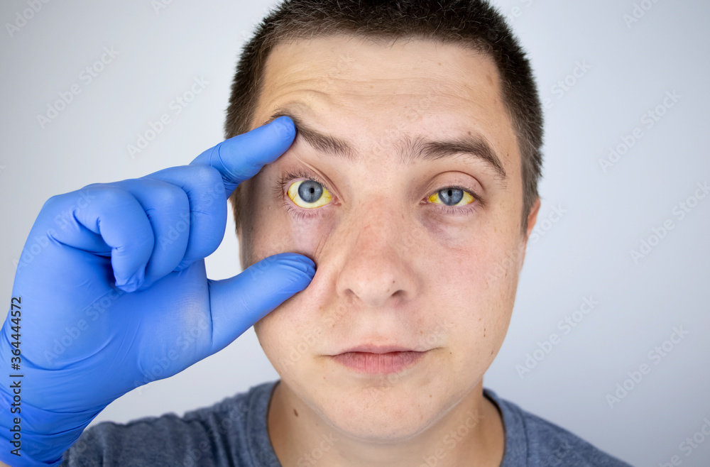 Foto de The yellow color of the male eye. Symptom of jaundice