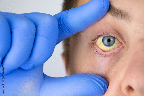 Photos The yellow color of the male eye
