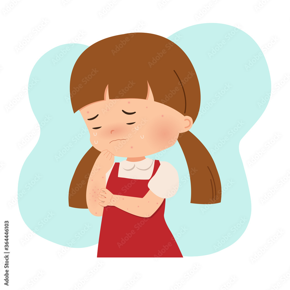 Little girl scratching her hands because of allergy. Chickenpox, pimples, acne, varicella. Contagious viral infection. Flat style vector isolated on white. Little girl scratching her hands because of allergy. Chickenpox, pimples, acne, varicella. Contagious viral infection. Flat style vector isolated on white.